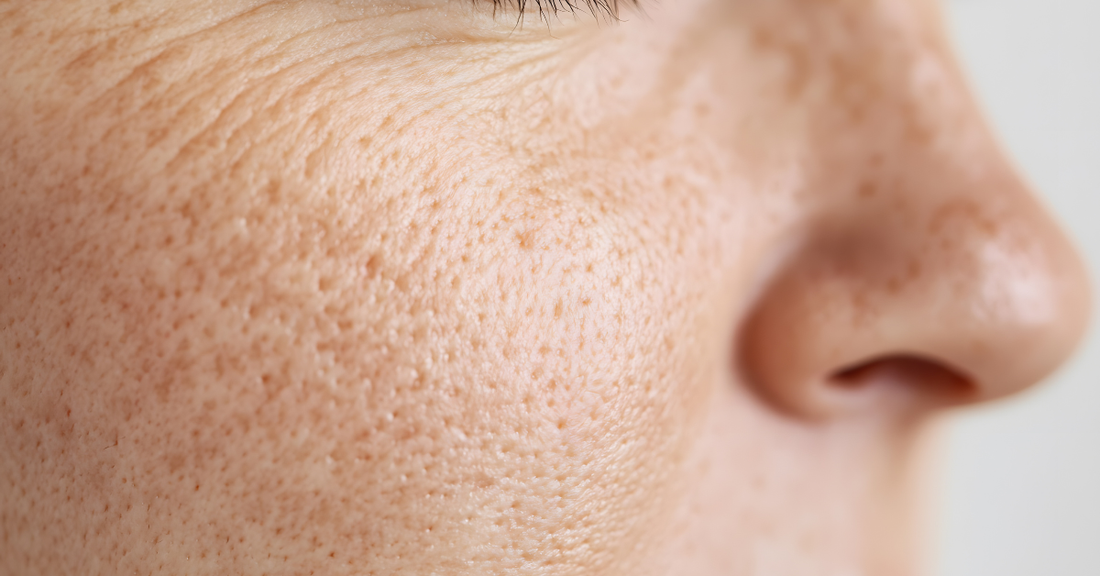 Pores de peau du visage indiquant un besoin d'exfoliation, d'hydratation