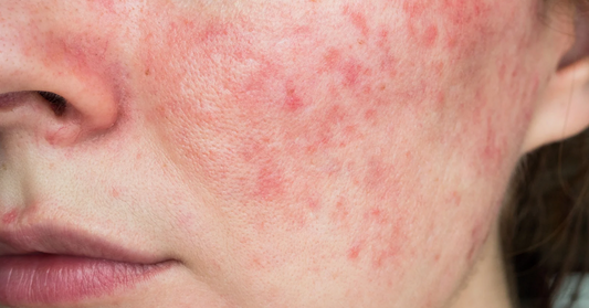 Peau avec de l'acné rosacée,  inflammation,  rougeur et papules