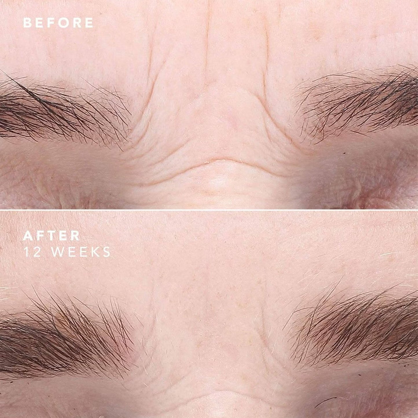 Résultats visibles sur la ride du lion après 12 semaines d’utilisation du sérum EGF. Peau visiblement plus lisse et repulpée.