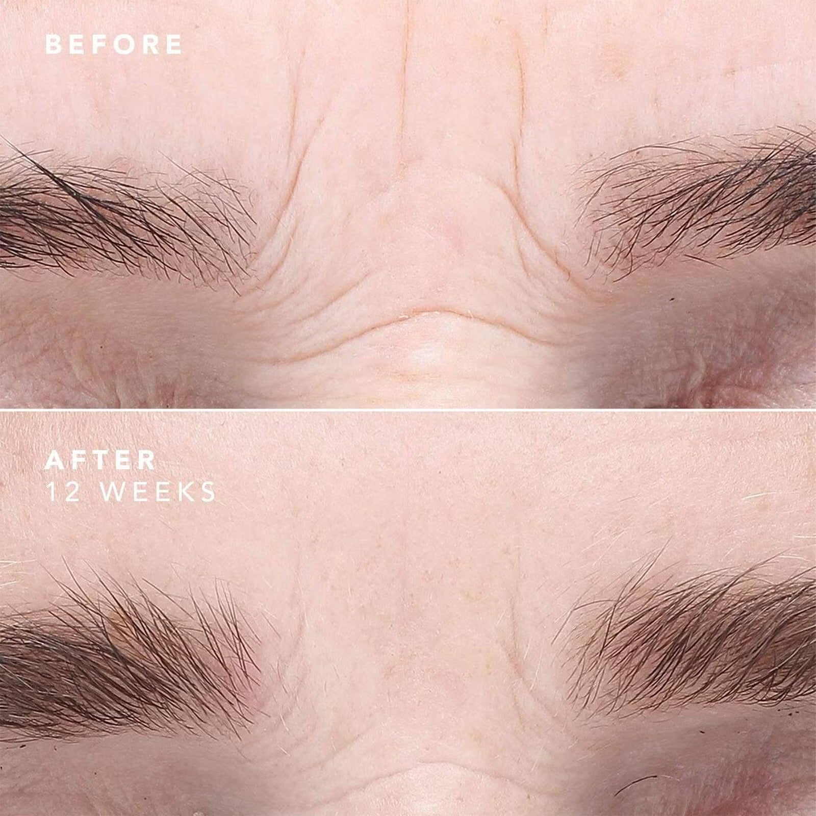 Résultats visibles sur la ride du lion après 12 semaines d’utilisation du sérum EGF. Peau visiblement plus lisse et repulpée.