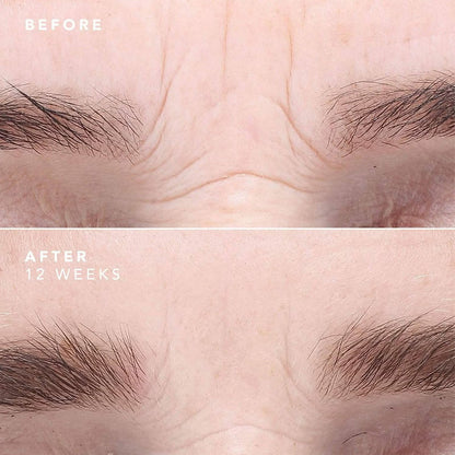 Résultats visibles sur la ride du lion après 12 semaines d’utilisation du sérum EGF. Peau visiblement plus lisse et repulpée.