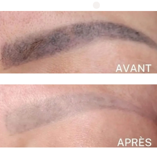 Résultat visible d’un détatouage à l’eau saline : éclaircissement progressif des pigments du maquillage permanent des sourcils, tout en douceur et sans agresser la peau.