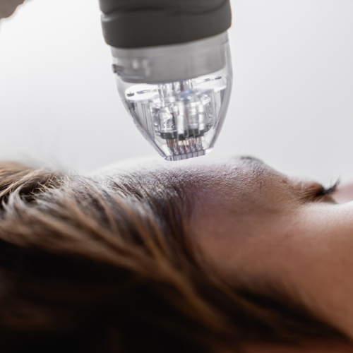 Procédure du microneedling pour améliorer l'aspect et la texture de la peau. Améliore la regénération de la peau